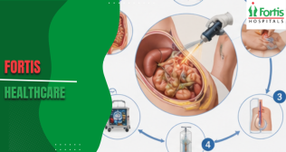HIPEC Surgery Procedure