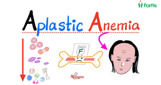 Aplastic Anemia in Children