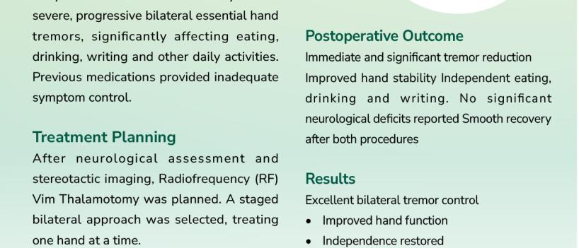 RADIOFREQUENCY ABLATION FOR SEVERE BILATERAL HAND TREMORS