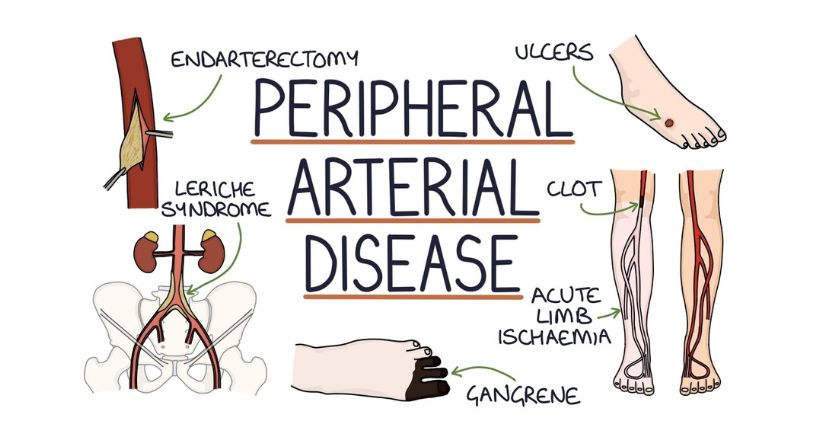 Peripheral Artery Disease (PAD): Symptoms and Treatment