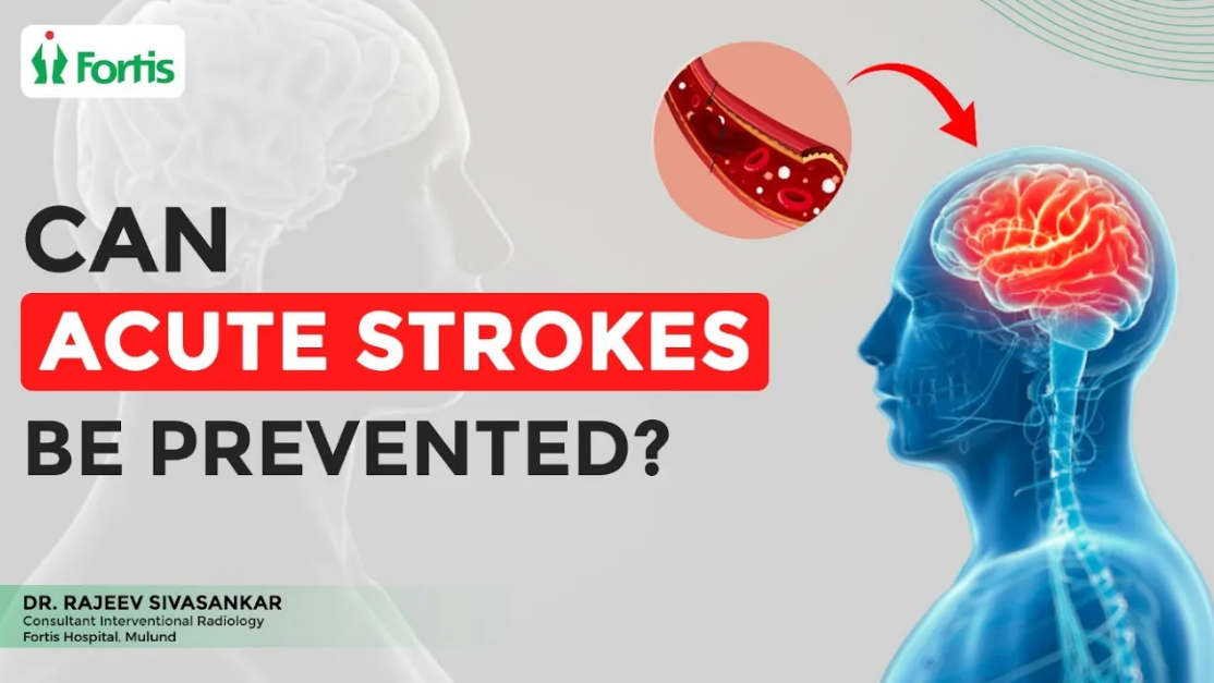 Can acute strokes be prevented? Factors That Can Cause Stroke| Dr. Rajeev Sivasankar | Fortis Mulund