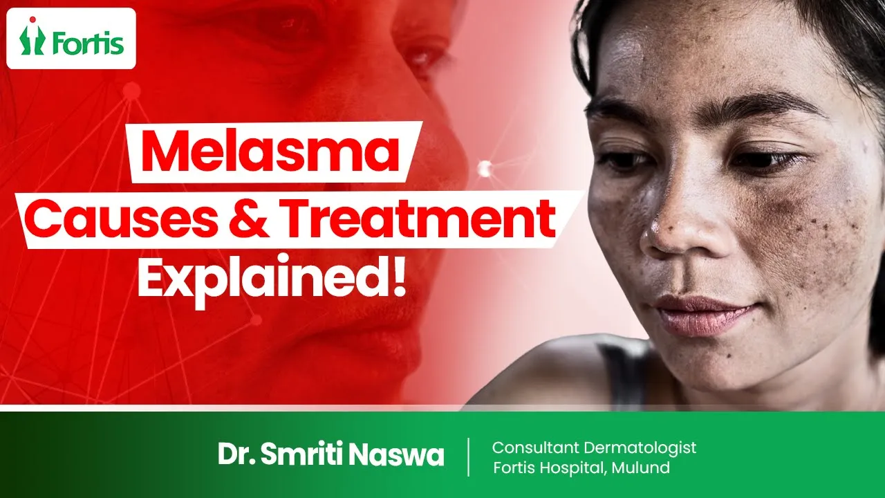 How To Treat Melasma On Face? How To Cure Melasma ? 