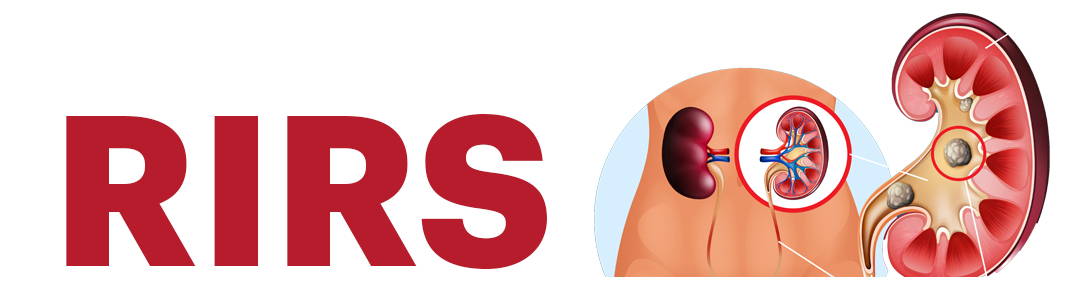 Rir R Iv Rim Retrograde Intrarenal Surgery (RIRS) at Fortis Hospital, Vasant Kunj ...