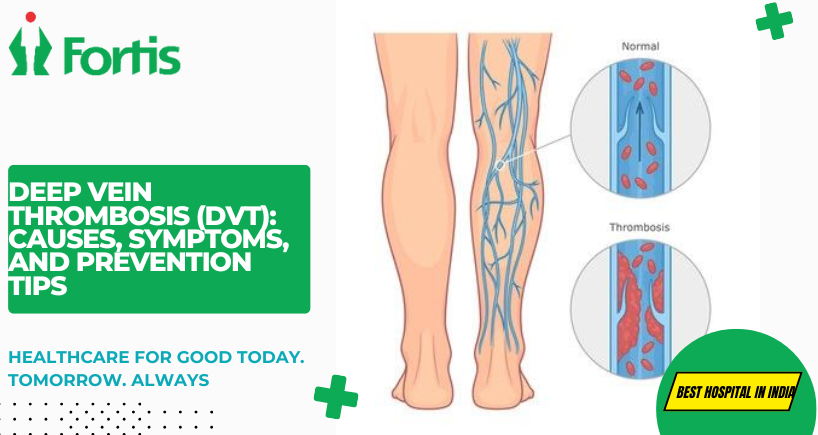 Is Dvt Reversible Deep Vein Thrombosis (DVT): Causes, Symptoms & Prevention