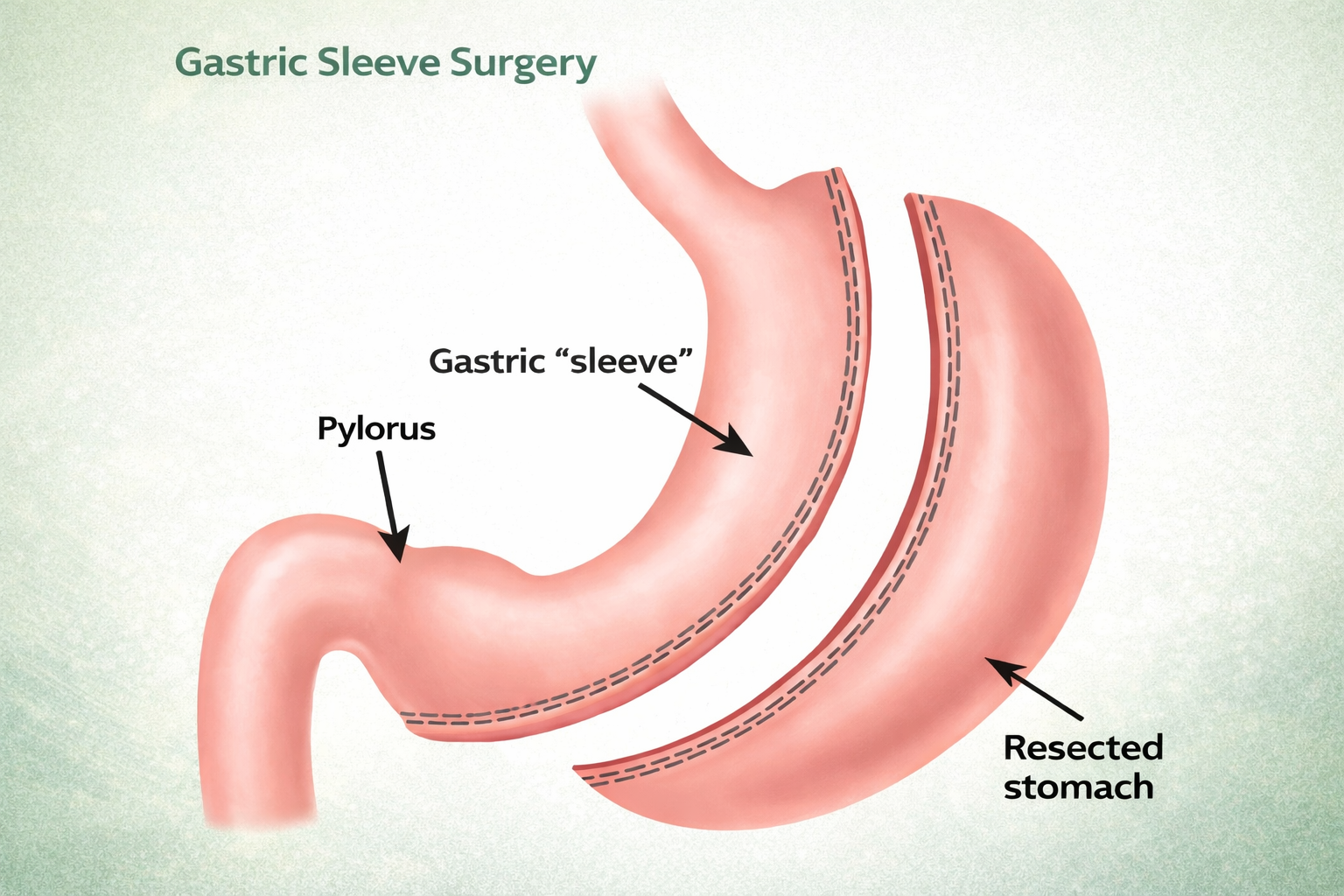 Gastric Sleev Surgery