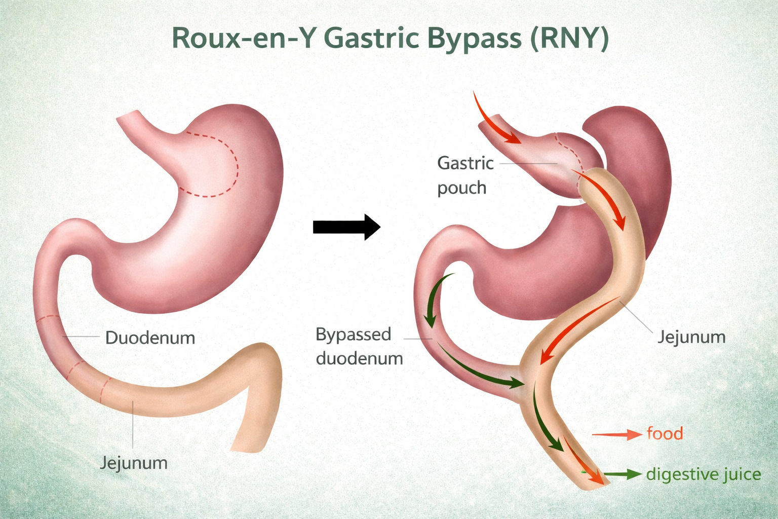 Roux-en-Y Gastric Bypass