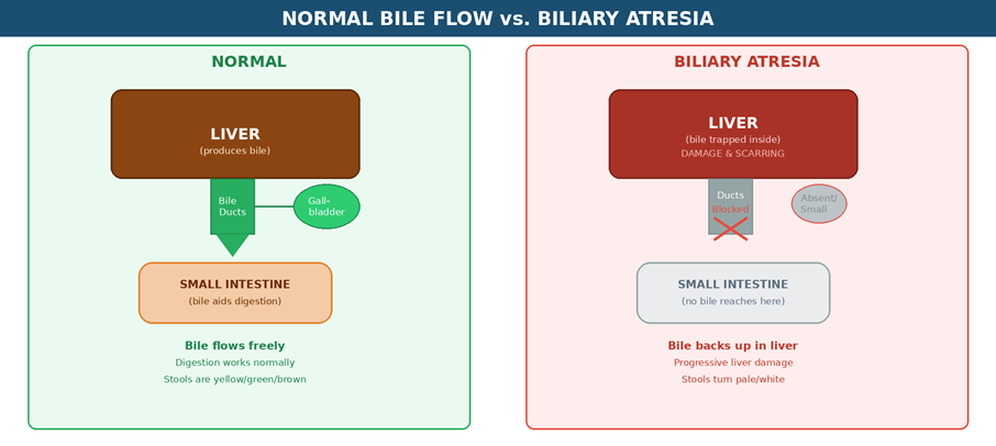 Fig. 1: Normal bile flow (left) versus biliary atresia (right). In EHBA, blocked ducts trap bile inside the liver, causing progressive damage.