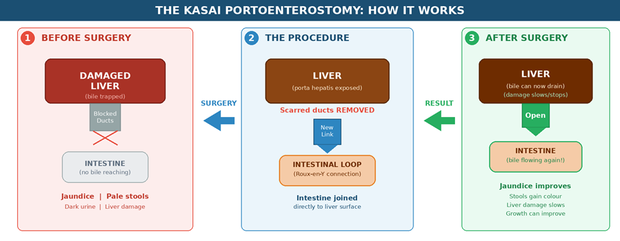 The Kasai Portoenterostomy — A simplified illustration of how the surgery restores bile flow by connecting the intestine directly to the liver