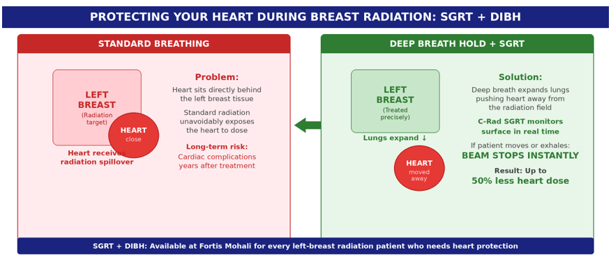 How SGRT + DIBH protects the heart during left-breast radiation — deep breathing pushes the heart away from the treatment field, and the C-Rad system ensures the beam stops if the patient moves.