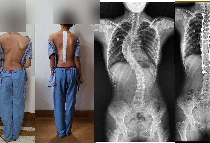 Scoliosis case study - 11959ee48e8c1522340d1b688ca4e05db94b99f6.png