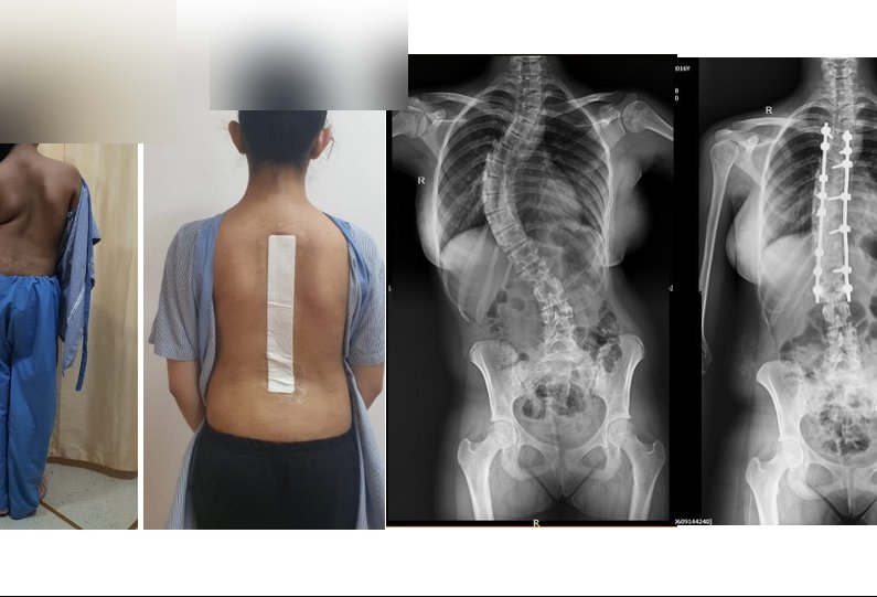 Scoliosis case study - a8cecd9025b073a43d650aad9f7deb94c836c812.png