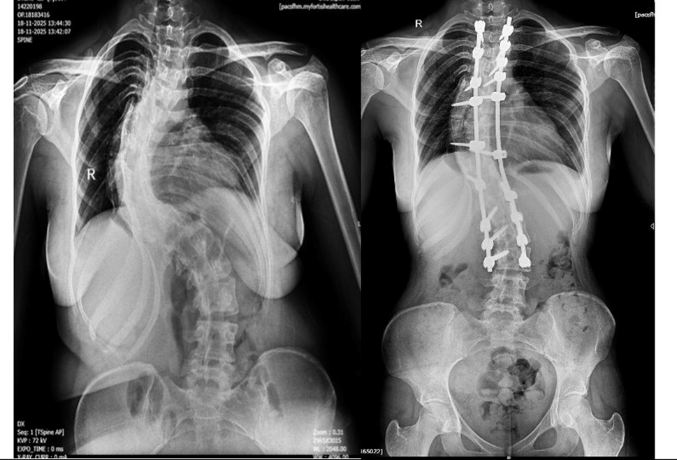 Adolescent Idiopathic Scoliosis