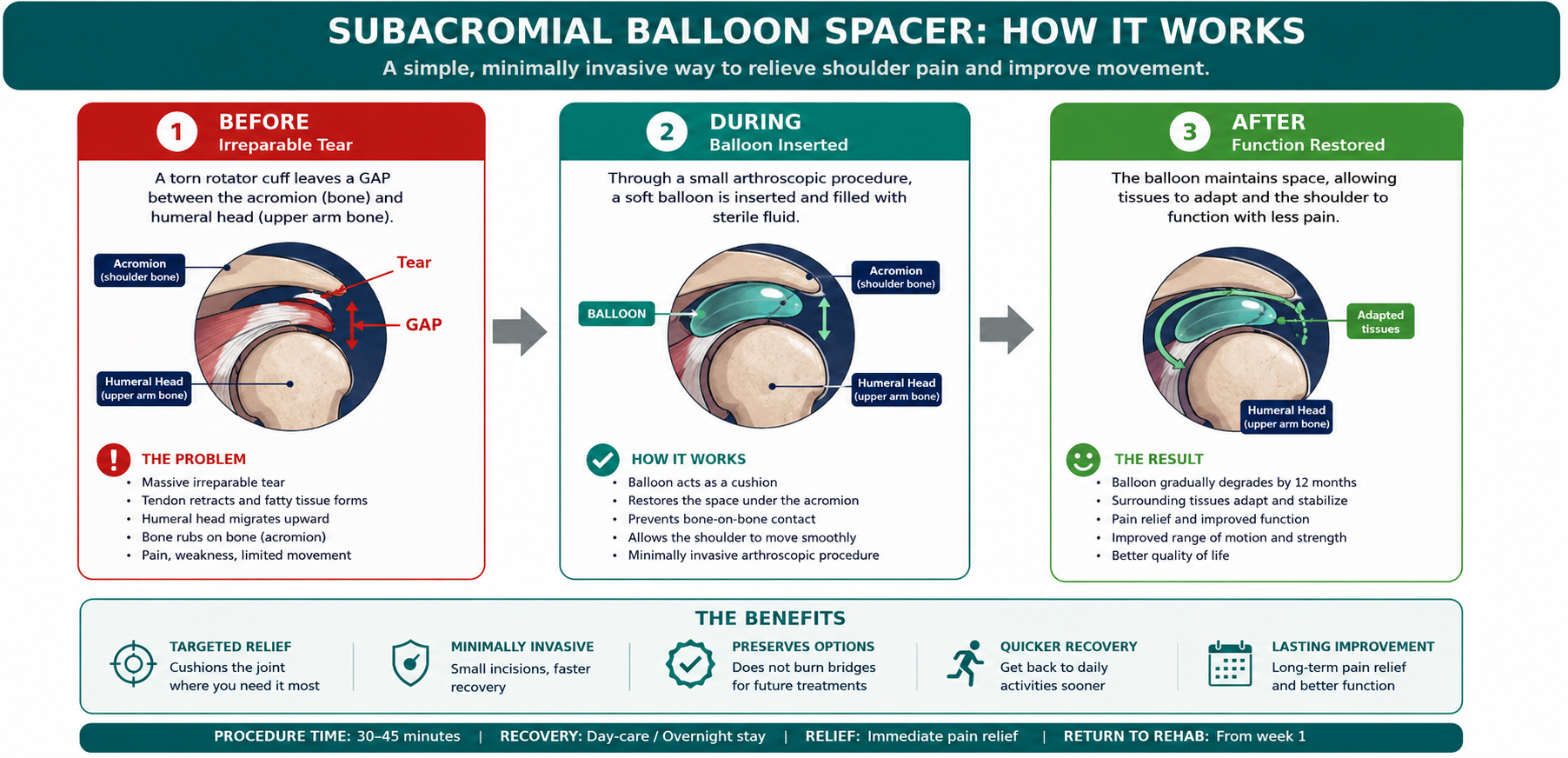The balloon spacer mechanism — from irreparable tear with upward humeral migration, through balloon insertion, to restored function as surrounding tissue adapts.