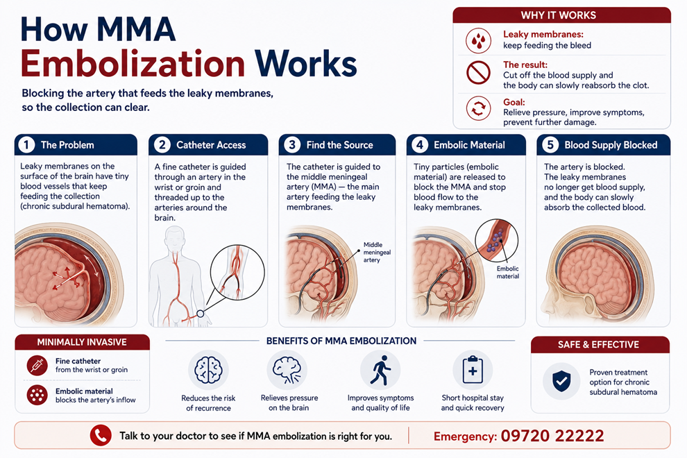 Figure 4: MMA embolization blocks the artery feeding the leaky membranes, so the collection can clear.