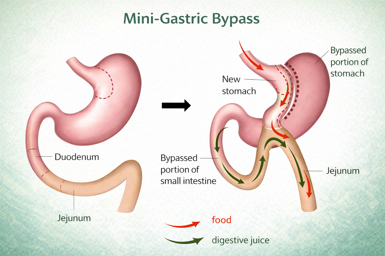 mini gastric pass