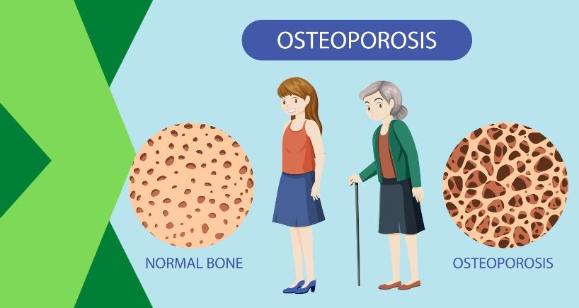 Stand-up & Reduce Risk of Osteoporosis