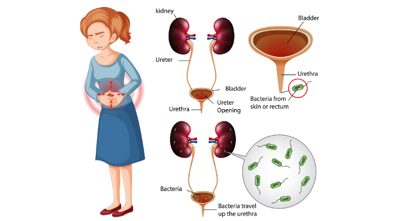Understanding Melena: What Does It Mean When You Have Dark Stools?