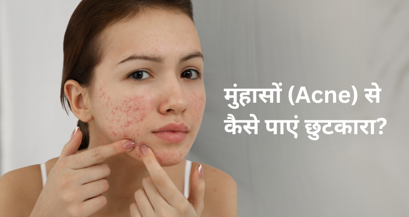 मुंहासों (Acne) से कैसे पाएं छुटकारा?