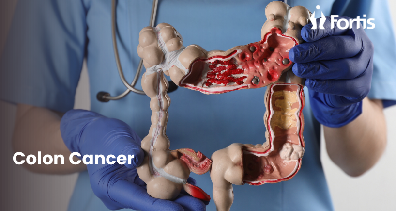 Best Colon Cancer Treatment in Mumbai