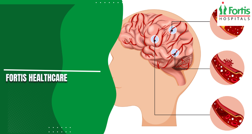 Transient Ischemic Attack
