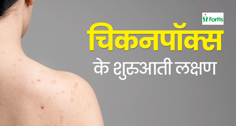 चिकनपॉक्स (Chickenpox)