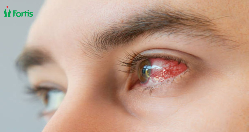 नेत्र फ्लू (Eye Flu) के लक्षण और बचाव के आसान तरीके