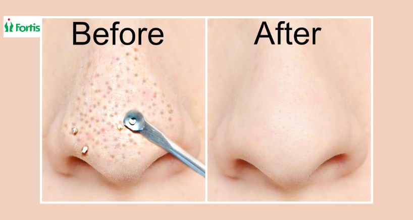 blackheads removal tips hindi