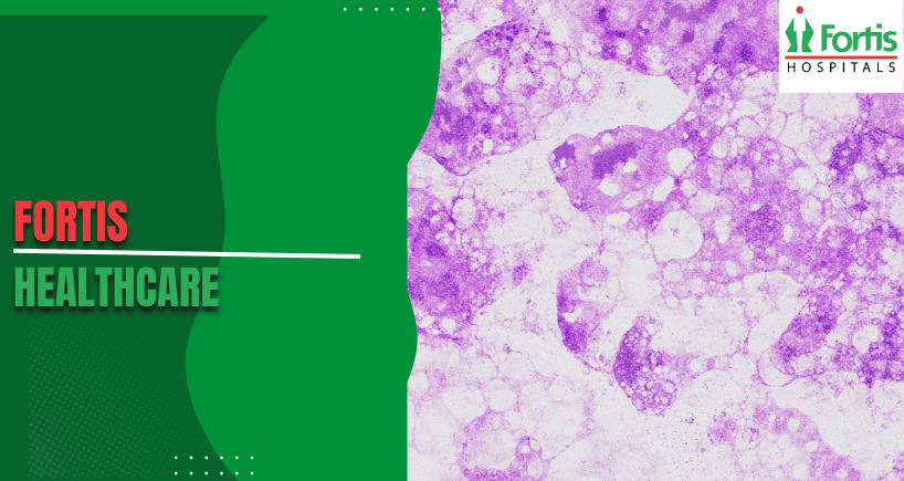 Pleomorphic Rhabdomyosarcoma