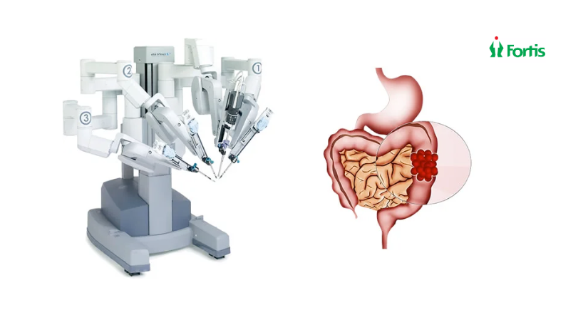 Robotics in Benign Colorectal Diseases