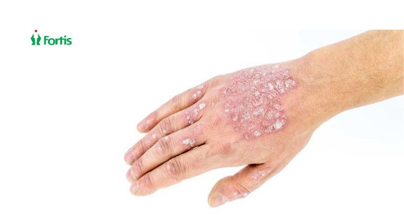 Symptoms of Psoriasis