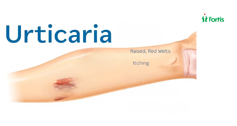 पित्ती (Urticaria) 