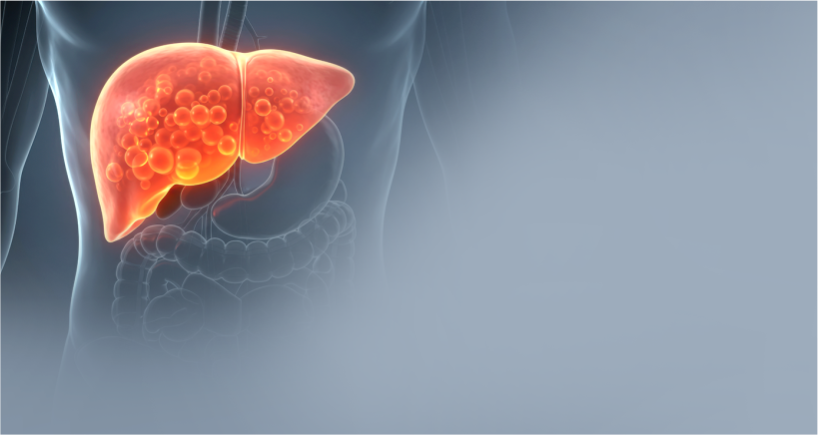 Fatty Liver Disease