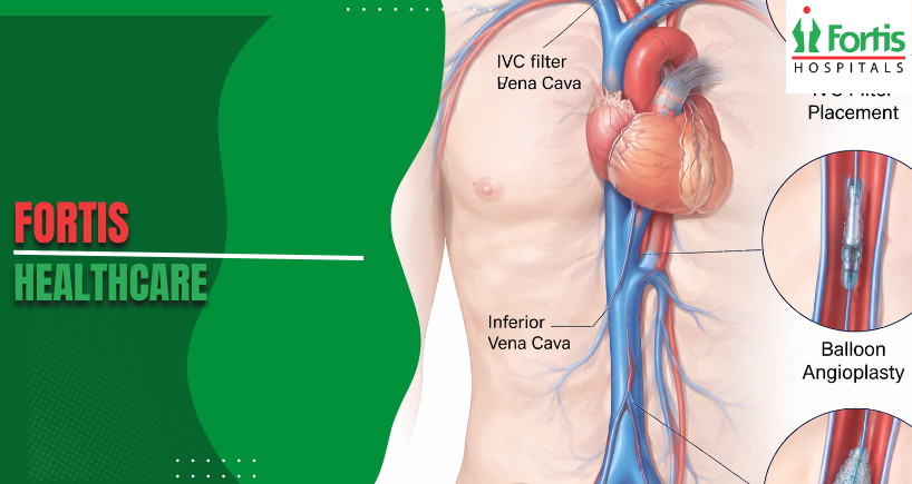 Inferior Vena Cava Procedures