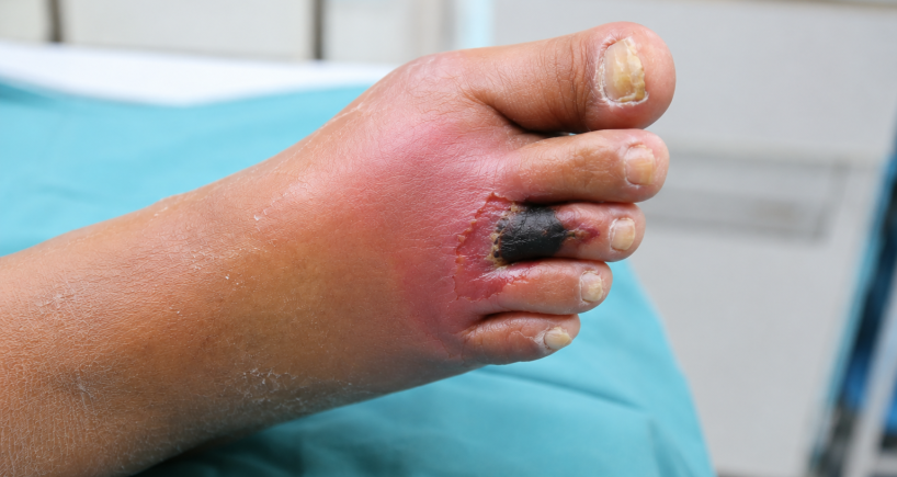 Diabetic Foot Infections