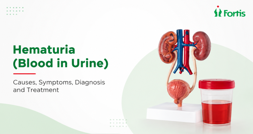 Best Hematuria (Blood in Urine) treatment in Navi Mumbai