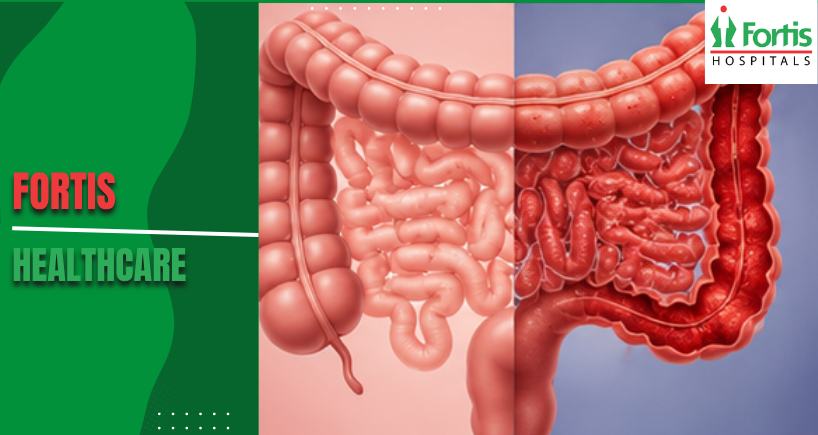 IBS vs IBD