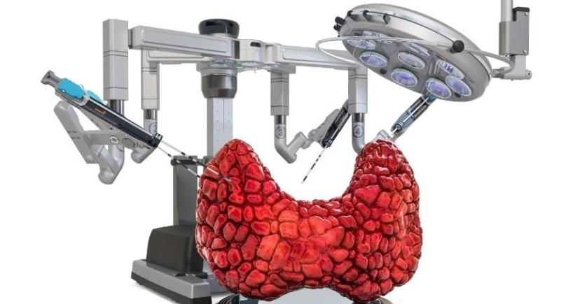Am I Eligible for Robotic Thyroidectomy