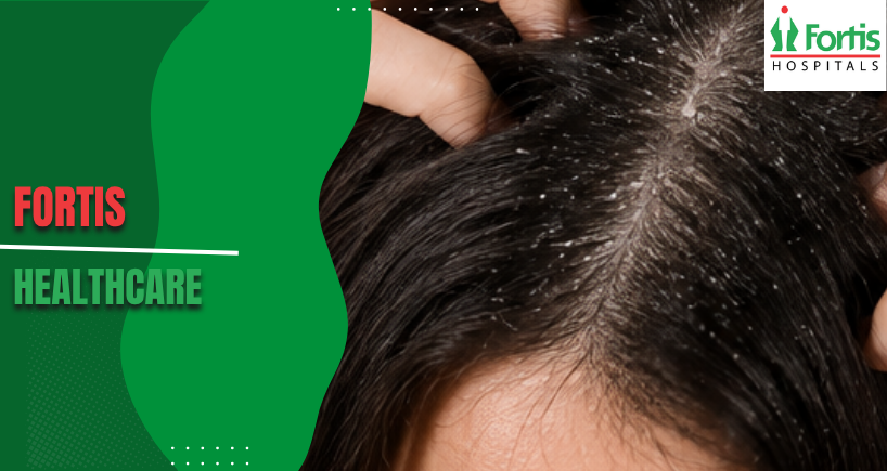 Dandruff Causes