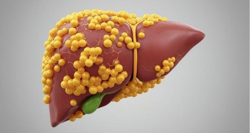 Fatty Liver