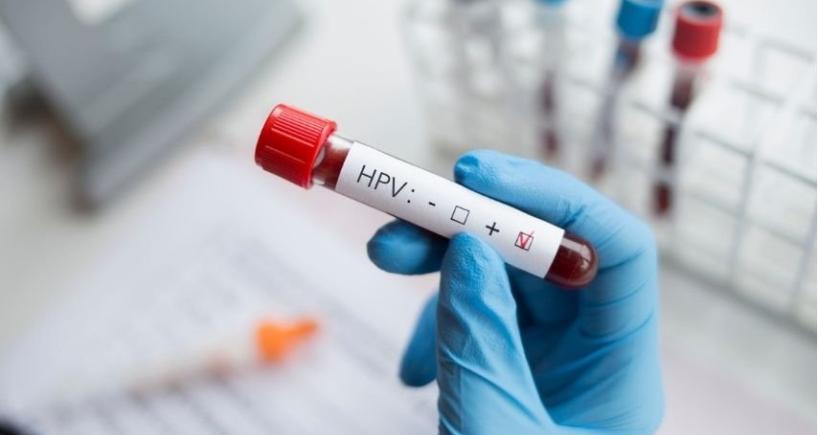 HPV-Positive vs HPV-Negative Head and Neck Cancer