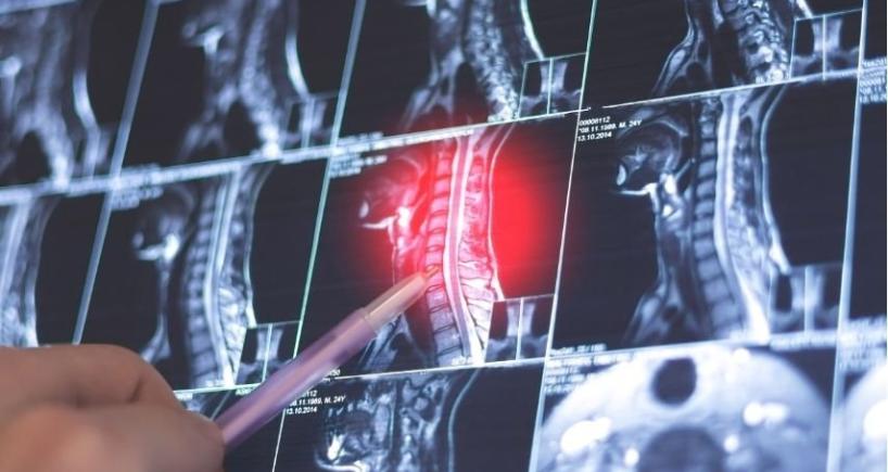 Slipped Disc Herniated Disc or Sciatica 
