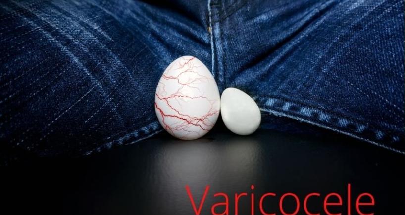 What Does Varicocele Embolization Feel Like-Real Patient Experience Explained