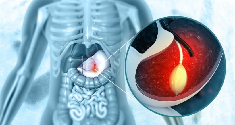 What Happens During a Therapeutic Polypectomy