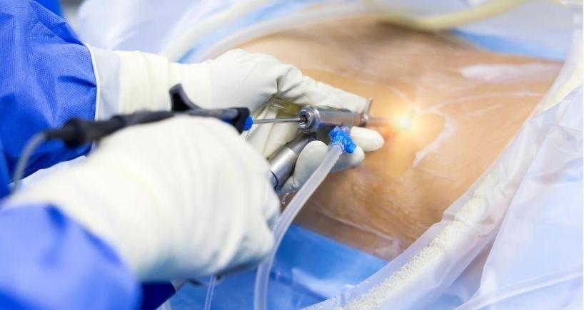 What Really Happens During Endoscopic Spine Surgery