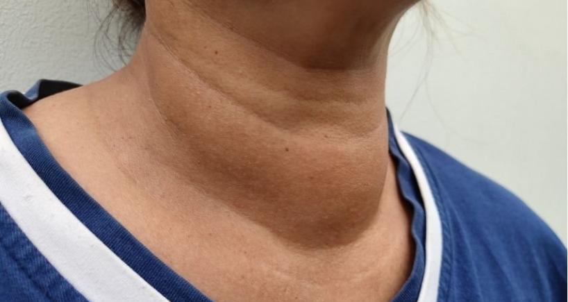 Why Is My Neck Swelling Getting Bigger