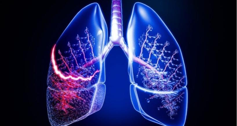 Bleeding or Lung Collapse