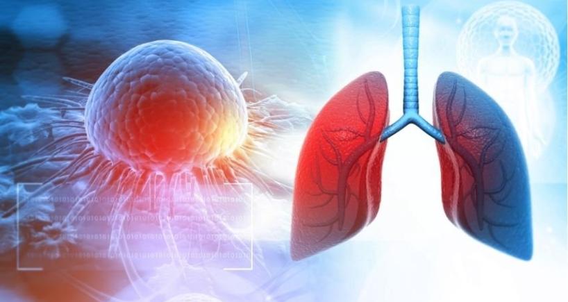 Lung Nodule Found on CT Scan
