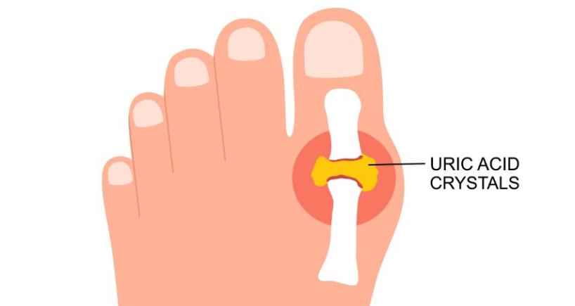 Uric Acid Symptoms