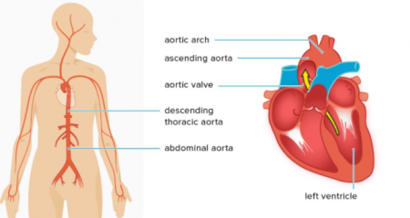 Know About Thoracic Aortic Dissection