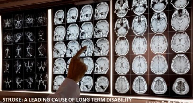 Stroke: A Leading Cause of Long Term Disability